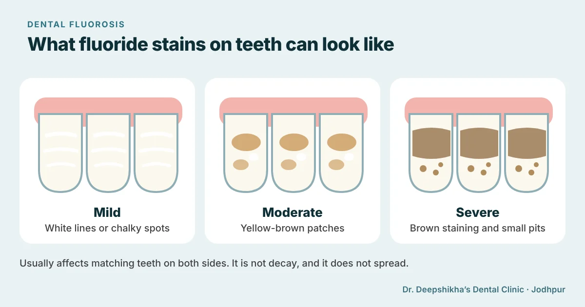 Illustration of front teeth with mild fluorosis (white lines and chalky spots), moderate fluorosis (yellow-brown patches) and severe fluorosis (brown staining and small pits)