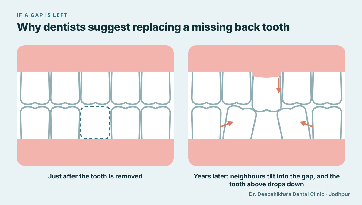 Diagram comparing a gap just after a back tooth is removed with years later, when the neighbouring teeth have tilted into the gap and the tooth above has moved down