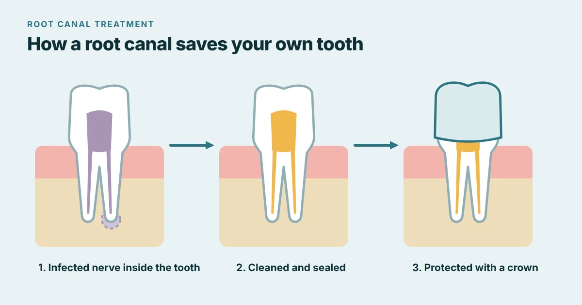Three-step diagram of root canal treatment: an infected nerve inside the tooth, the canals cleaned and sealed, and the tooth protected with a crown