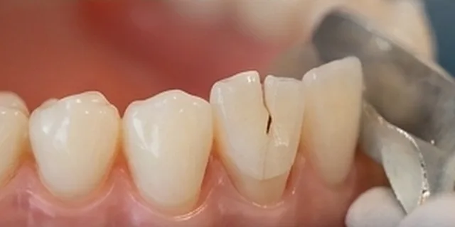 Broken or Chipped Tooth: illustration