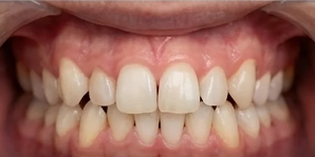 Crooked Teeth & Gaps: illustration