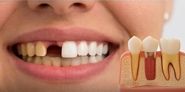 Missing Teeth: illustration