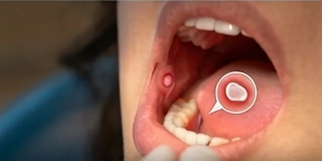 Mouth Ulcers: illustration