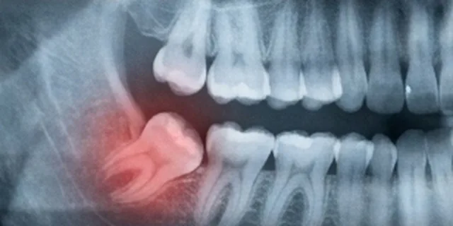 Wisdom Tooth Pain: illustration