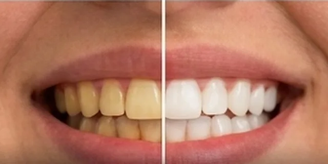 Yellow or Stained Teeth: illustration